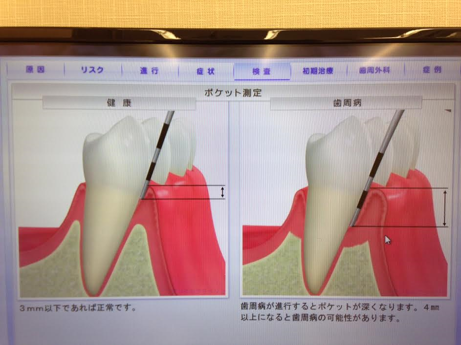 歯周ポケットとは？
