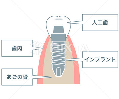 私のインプラント最後の報告です☆