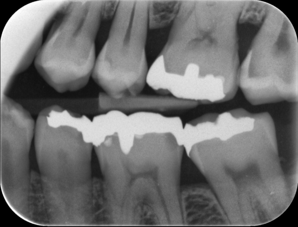 銀 歯 の 下 虫歯 レントゲン