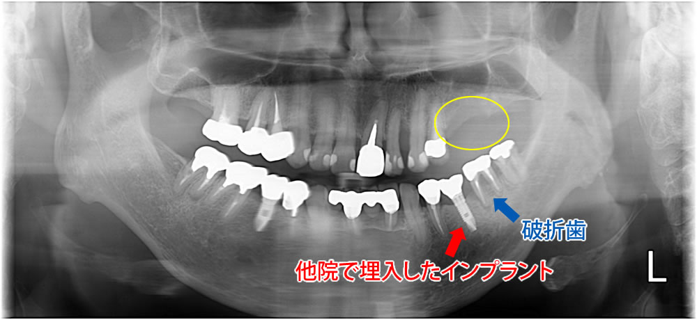 来院時のお口のレントゲン画像