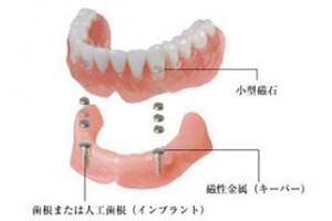 磁力で固定するマグネットデンチャー