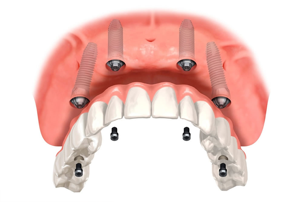インプラントフルブリッジ（オールオン4）