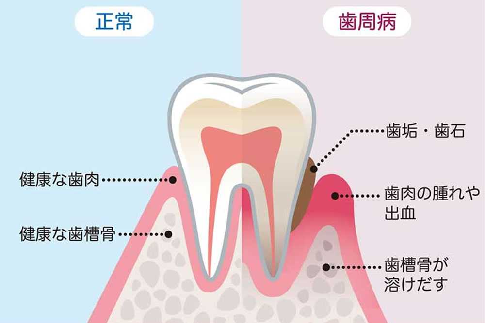 歯周病とは？